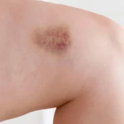 Pack 10 Jabón Natural De Árnica - Mejora Las Varices Y Hematomas - Alivia Las Piernas Cansadas - Cara Y Cuerpo