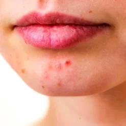 Pack 5 Jabón Natural Exfoliante Limón - Regula El Nivel De Grasa - Evita El Acné Y Aclara Sus Marcas - Exfoliante Suave